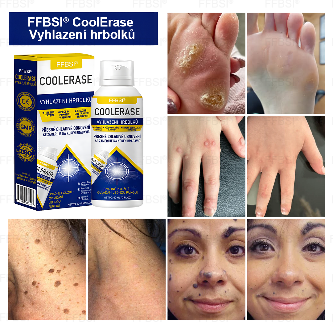 FFBSI® 💕 CoolErase Sprej pro regeneraci pokožky (Bradavice, Puchýře, Ekzém, Lupy, Kožní keratózy, Akné, Kožní výrůstky, Jizvy, Mateřská znaménka)