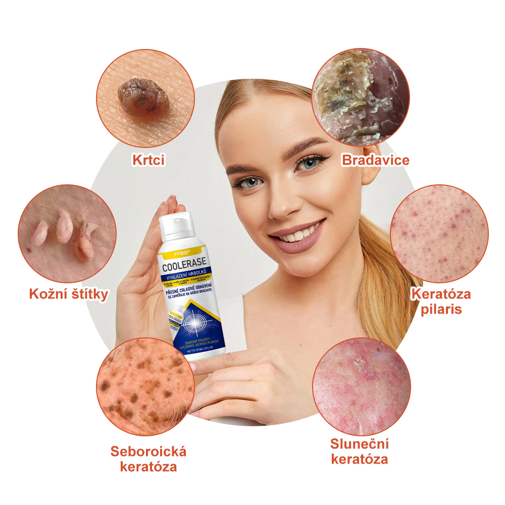 FFBSI® 💕 CoolErase Sprej pro regeneraci pokožky (Bradavice, Puchýře, Ekzém, Lupy, Kožní keratózy, Akné, Kožní výrůstky, Jizvy, Mateřská znaménka)