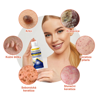 FFBSI® 💕 CoolErase Sprej pro regeneraci pokožky (Bradavice, Puchýře, Ekzém, Lupy, Kožní keratózy, Akné, Kožní výrůstky, Jizvy, Mateřská znaménka)