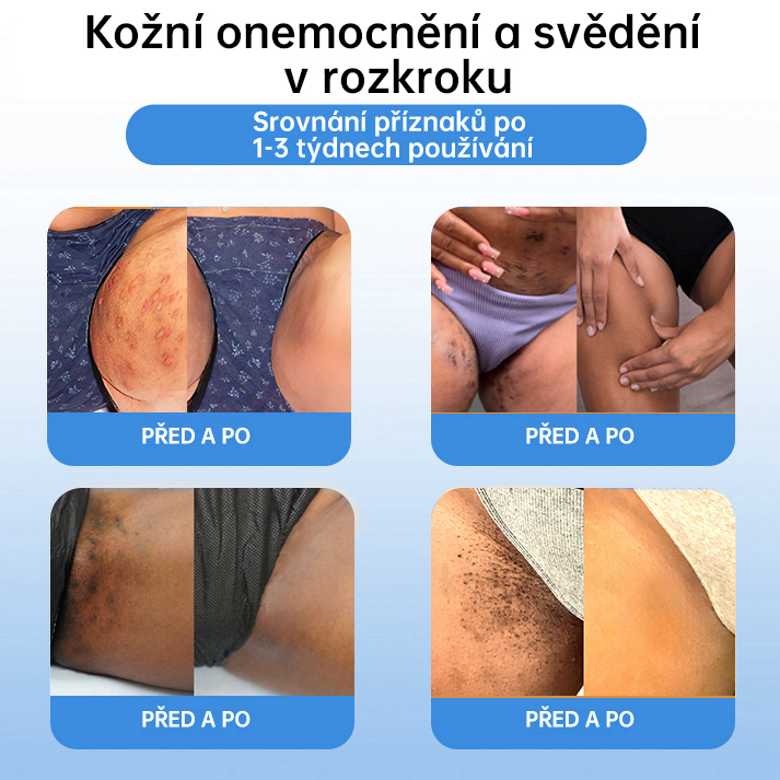 FFBSI® 💕 CoolErase Sprej pro regeneraci pokožky (Bradavice, Puchýře, Ekzém, Lupy, Kožní keratózy, Akné, Kožní výrůstky, Jizvy, Mateřská znaménka)