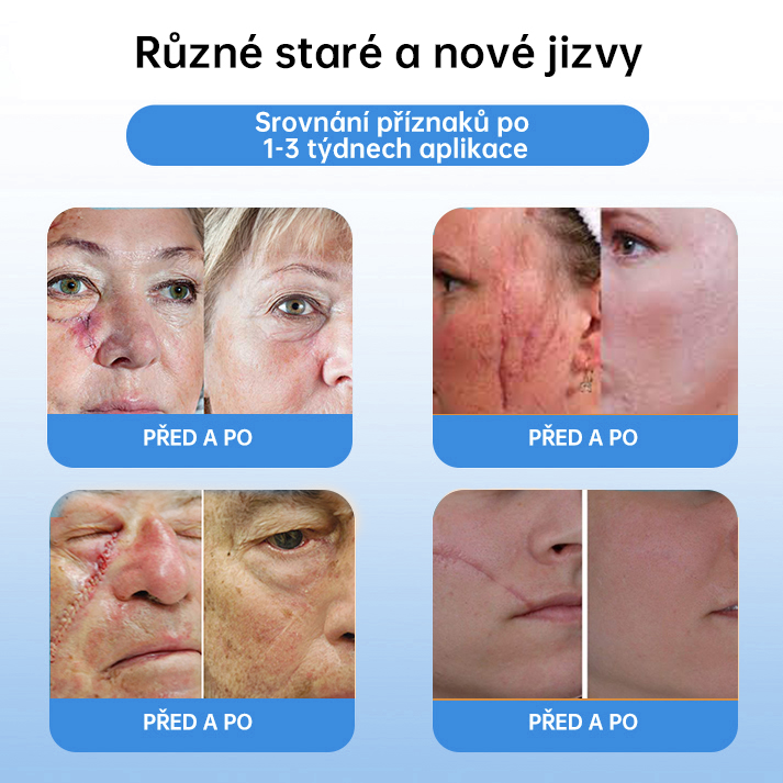 FFBSI® 💕 CoolErase Sprej pro regeneraci pokožky (Bradavice, Puchýře, Ekzém, Lupy, Kožní keratózy, Akné, Kožní výrůstky, Jizvy, Mateřská znaménka)