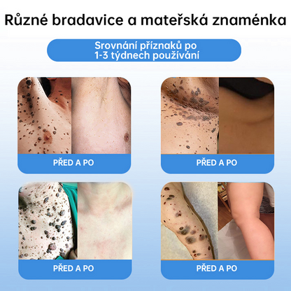 FFBSI® 💕 CoolErase Sprej pro regeneraci pokožky (Bradavice, Puchýře, Ekzém, Lupy, Kožní keratózy, Akné, Kožní výrůstky, Jizvy, Mateřská znaménka)