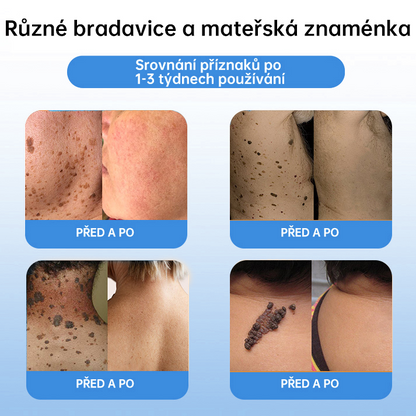 FFBSI® 💕 CoolErase Sprej pro regeneraci pokožky (Bradavice, Puchýře, Ekzém, Lupy, Kožní keratózy, Akné, Kožní výrůstky, Jizvy, Mateřská znaménka)
