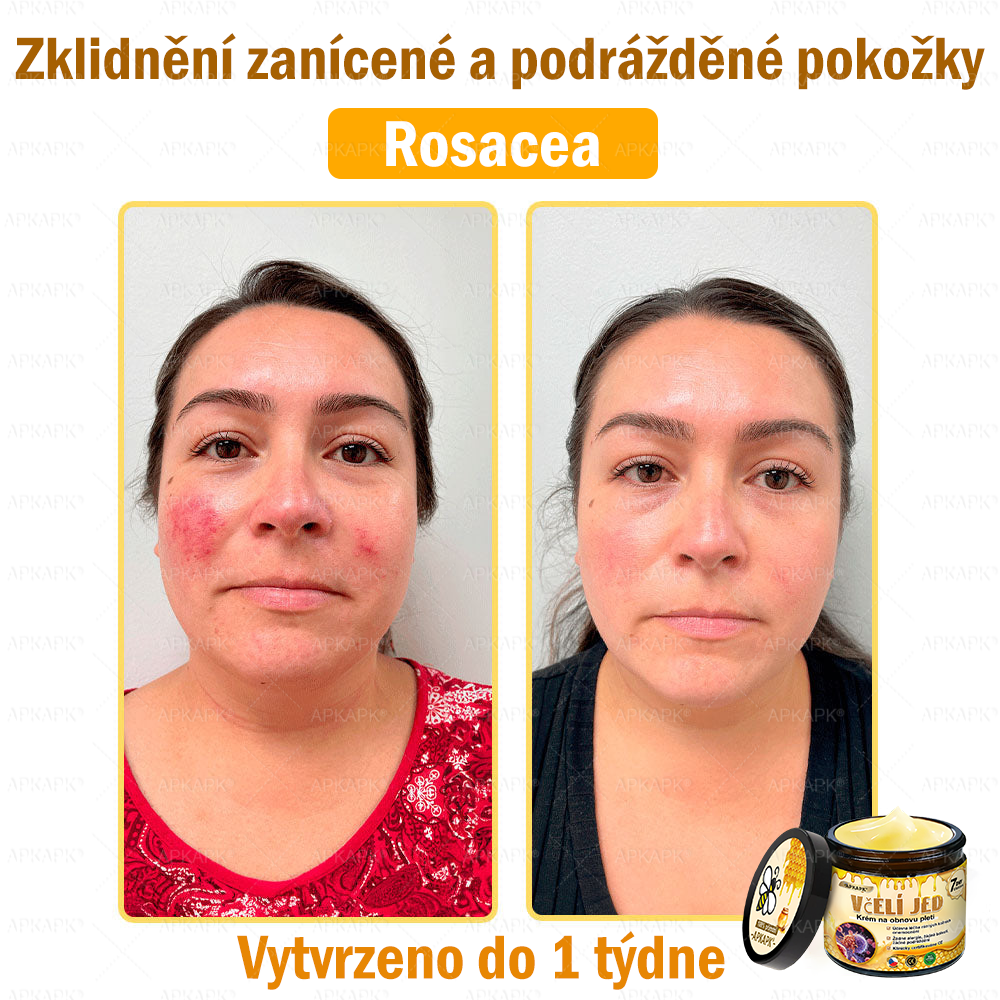 Dermatologicky a klinicky testováno👩‍⚕️APKAPK®Bee Venom Krém na obnovení pleti🐝 pomáhá při léčbě kožních problémů, jako jsou: vrásky, jizvy, pigmentové skvrny, strie, akné, psoriáza, ekzém, kožní změny, podráždění, záněty a další kožní problémy.