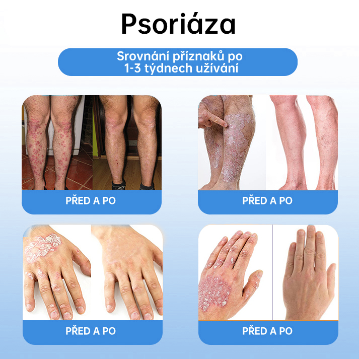 FFBSI® 💕 CoolErase Sprej pro regeneraci pokožky (Bradavice, Puchýře, Ekzém, Lupy, Kožní keratózy, Akné, Kožní výrůstky, Jizvy, Mateřská znaménka)