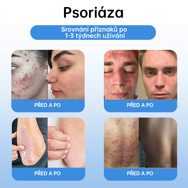 FFBSI® 💕 CoolErase Sprej pro regeneraci pokožky (Bradavice, Puchýře, Ekzém, Lupy, Kožní keratózy, Akné, Kožní výrůstky, Jizvy, Mateřská znaménka)