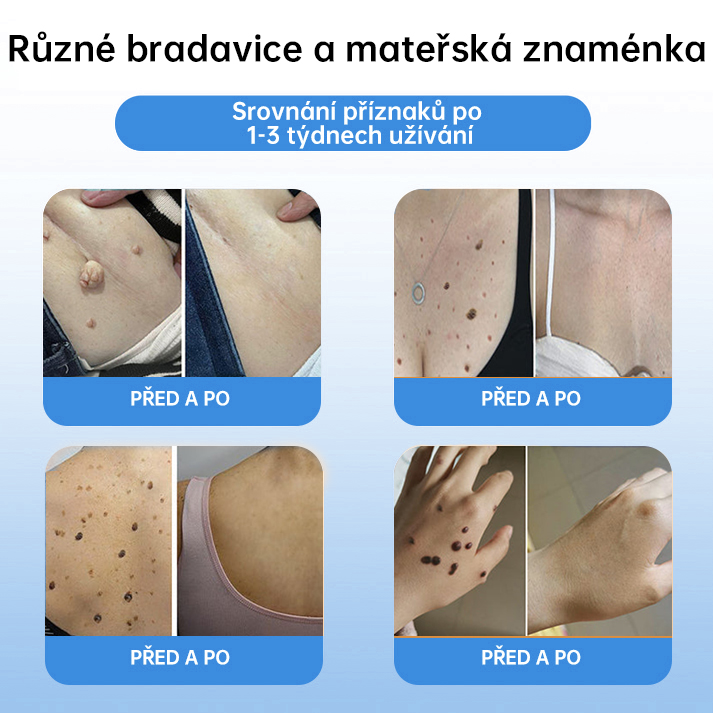 FFBSI® 💕 CoolErase Sprej pro regeneraci pokožky (Bradavice, Puchýře, Ekzém, Lupy, Kožní keratózy, Akné, Kožní výrůstky, Jizvy, Mateřská znaménka)