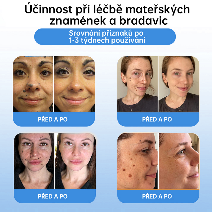 FFBSI® 💕 CoolErase Sprej pro regeneraci pokožky (Bradavice, Puchýře, Ekzém, Lupy, Kožní keratózy, Akné, Kožní výrůstky, Jizvy, Mateřská znaménka)